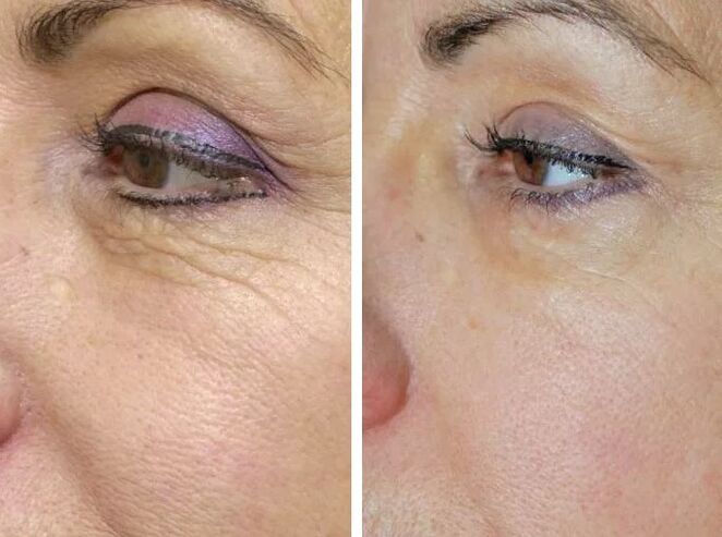 Feld Laser virun an no